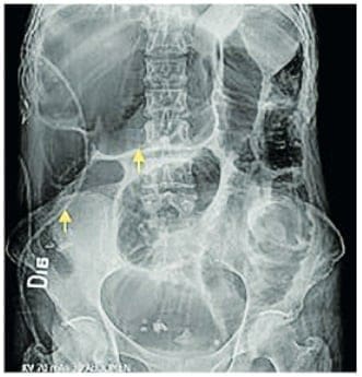 Vólvulo del ciego - Manifestación Gastrointestinal de la Esclerosis Sistémica Vólvulo del ciego - Manifestación Gastrointestinal de la Esclerosis Sistémica