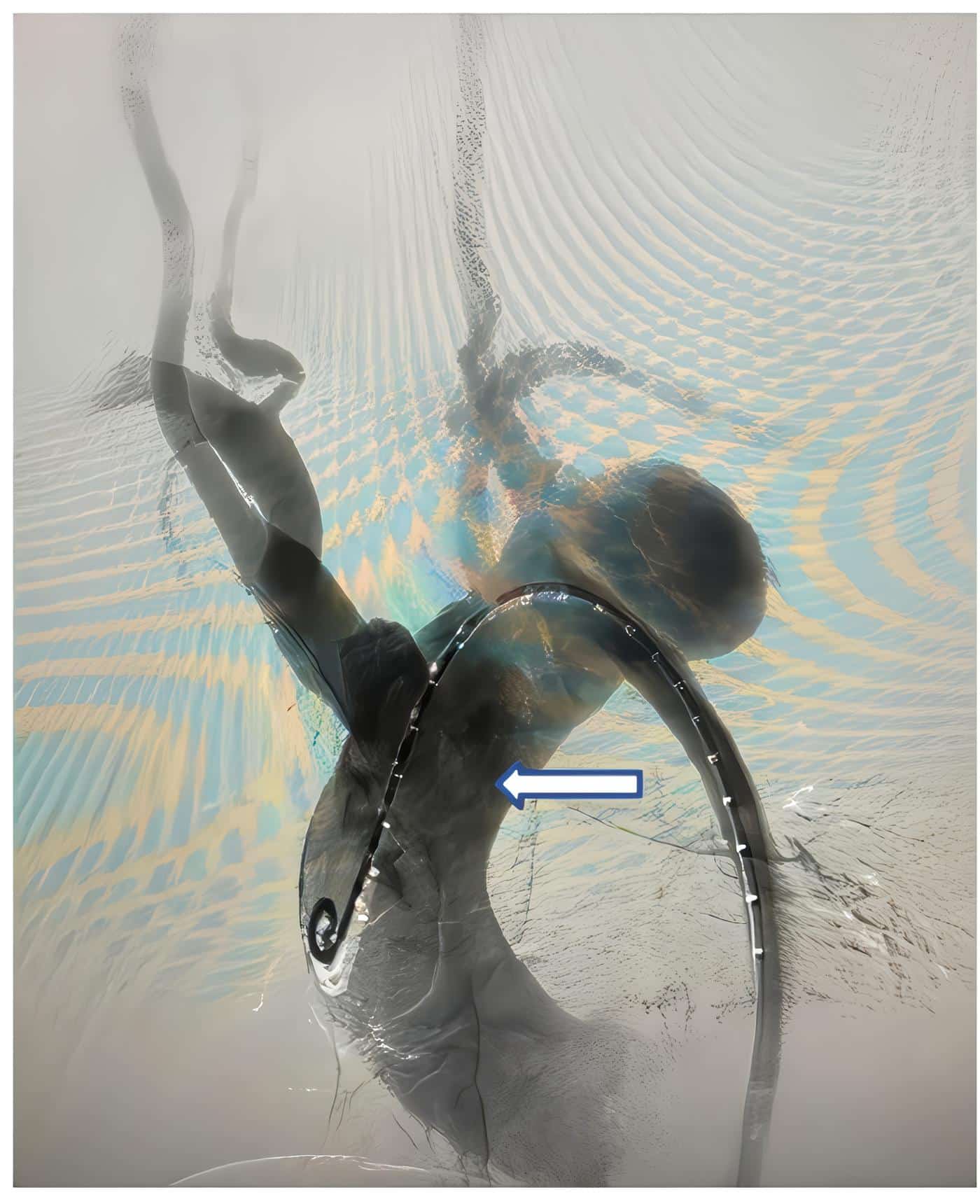 Angiografía sin zona de anclaje proximal