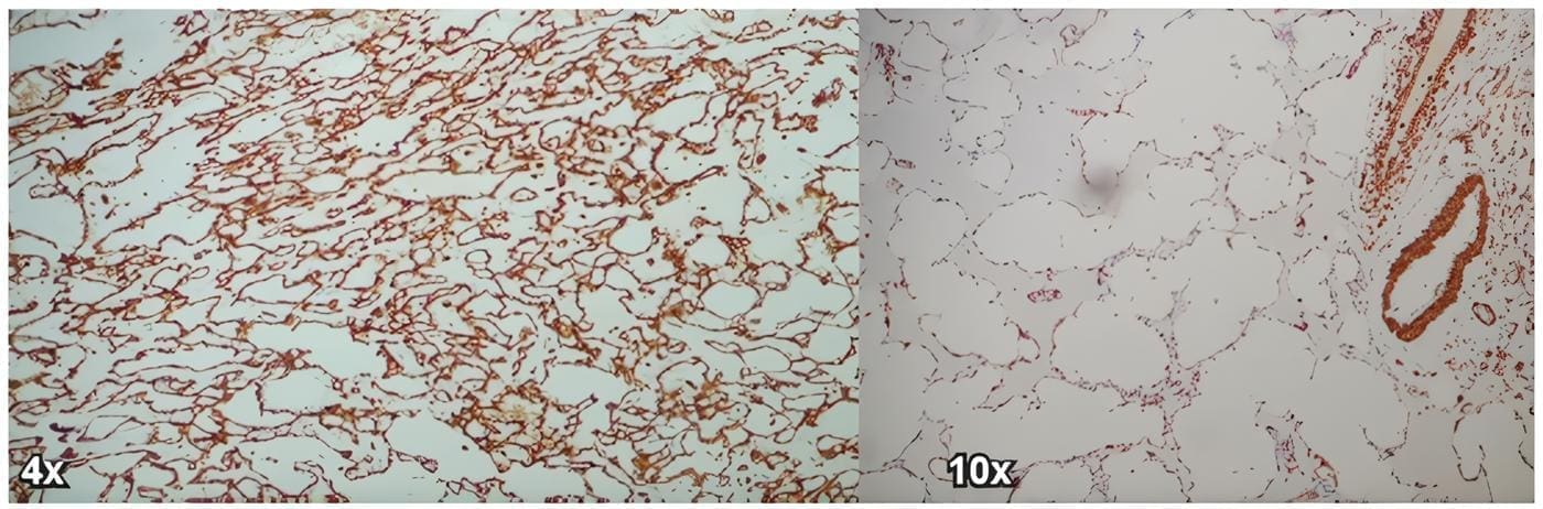 Marcador de inmunohistoqumica CD31 y ERG del angiosarcoma de mama de la paciente