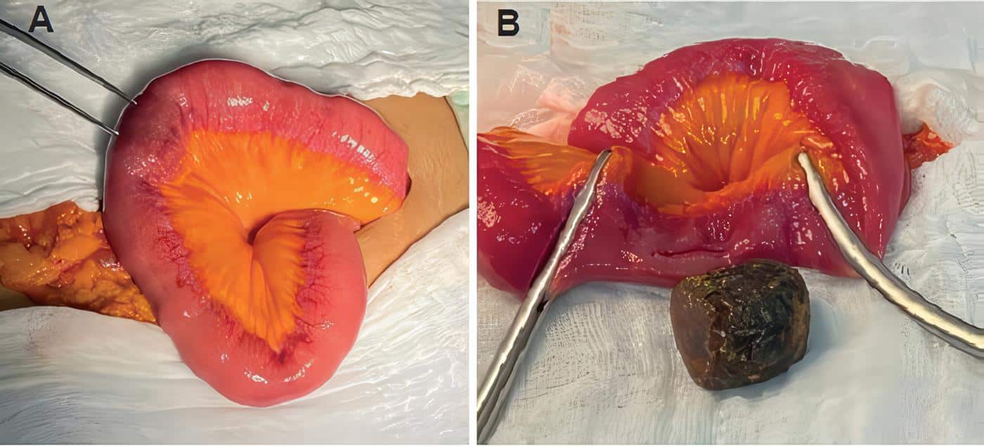 Cálculo biliar extraído de la luz intestinal mediante enterotomía longitudinal Cálculo biliar extraído de la luz intestinal mediante enterotomía longitudinal