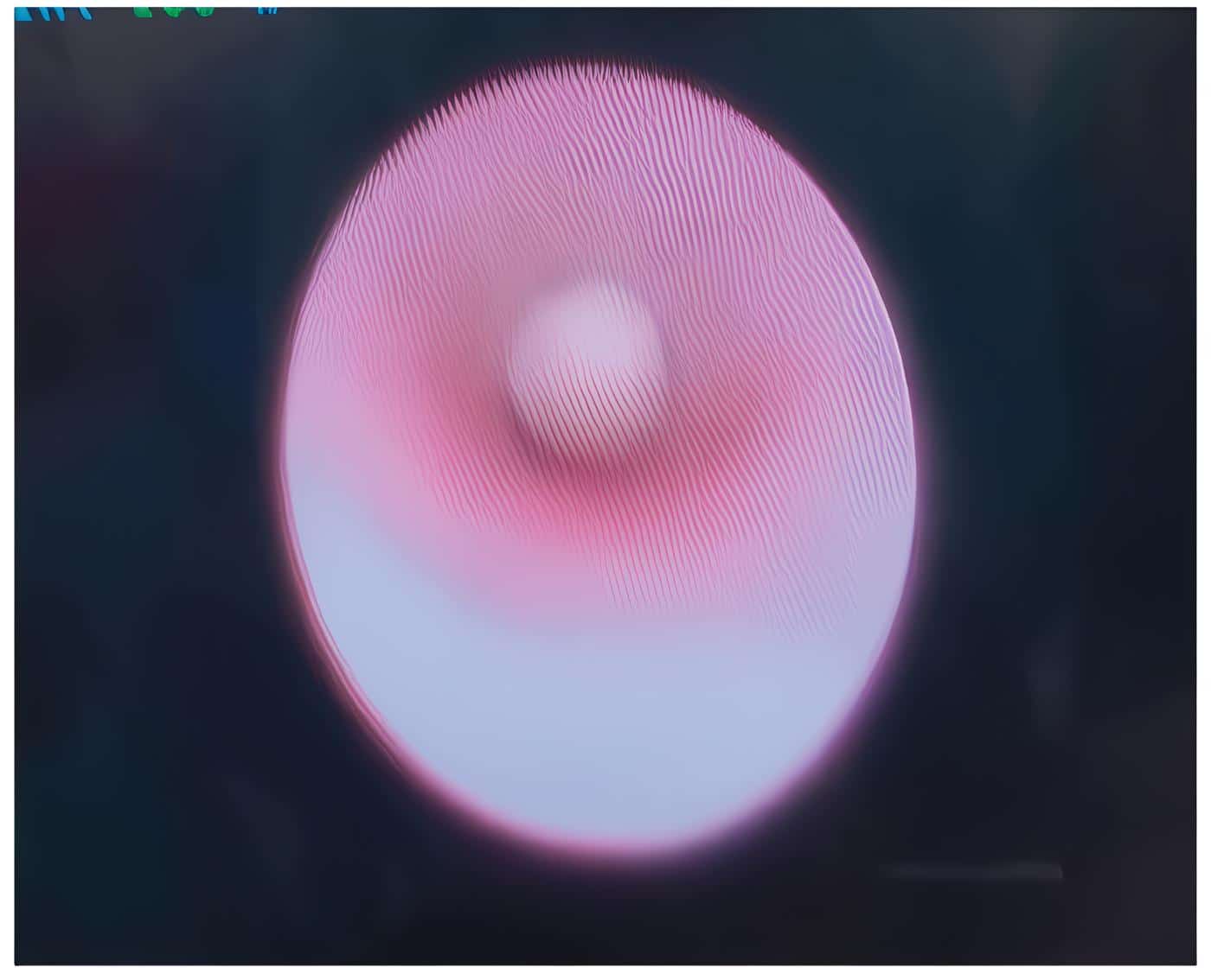 Calculo flotante tratado con sialoendoscopia Calculo flotante tratado con sialoendoscopia