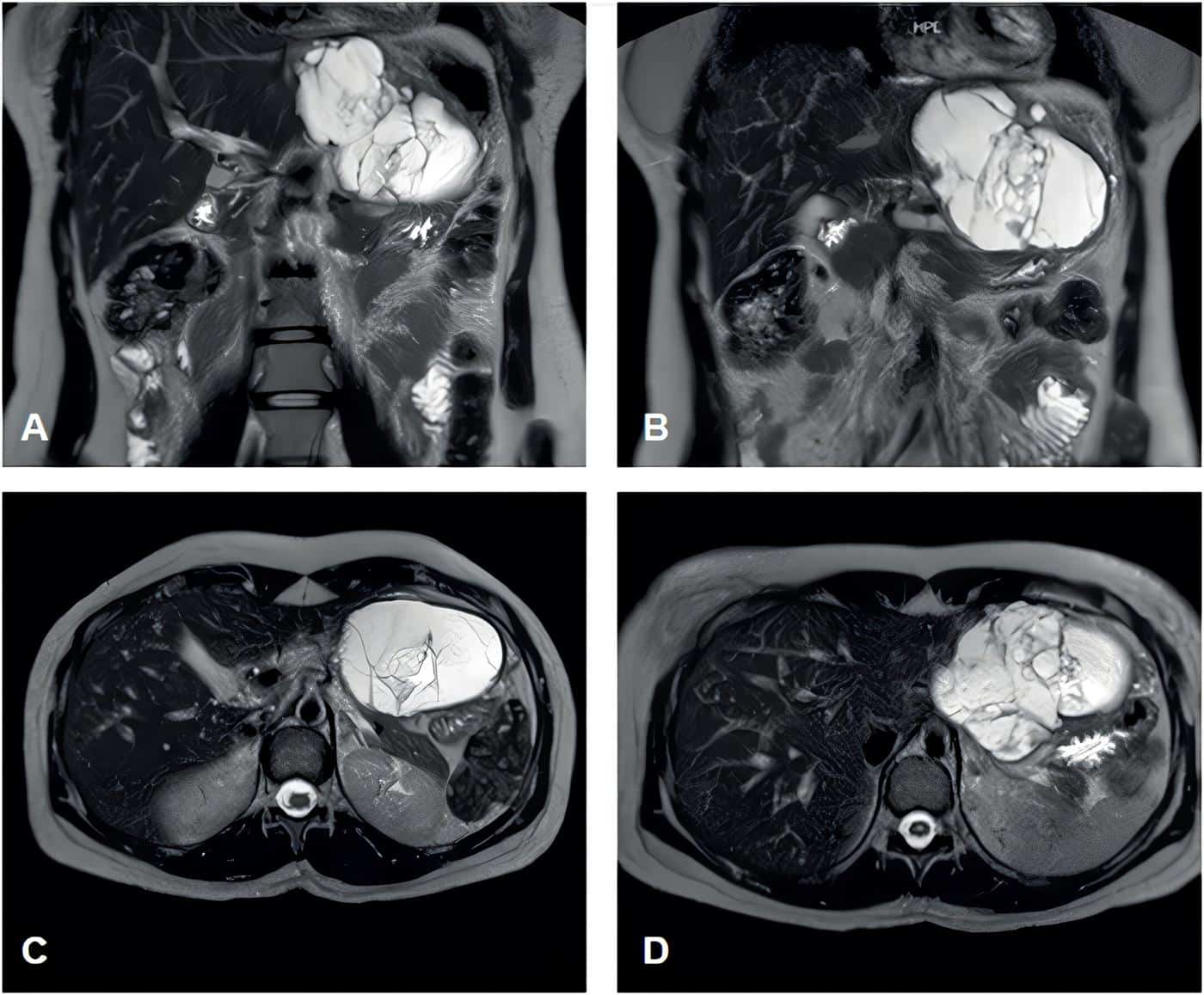 Cortes axiales de la colangioresonancia en secuencia T2 Cortes axiales de la colangioresonancia en secuencia T2