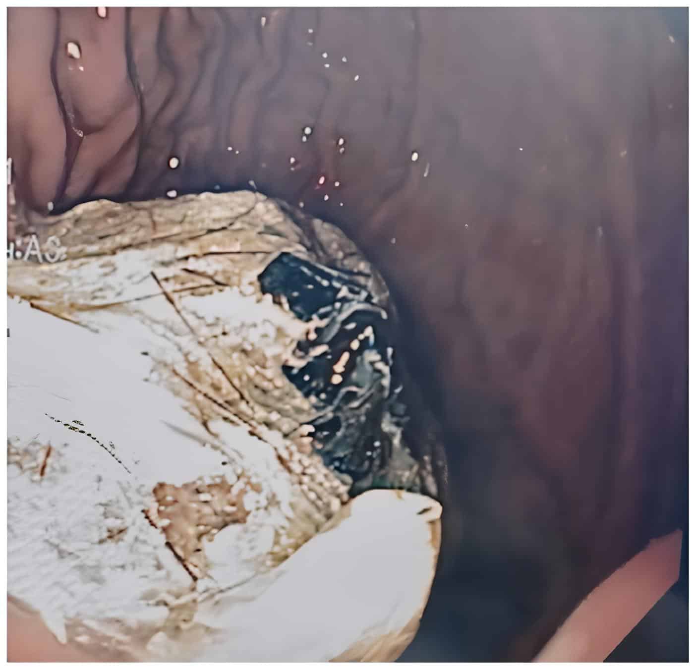 Diagnóstico de tricobezoar - síndrome de Rapunzel