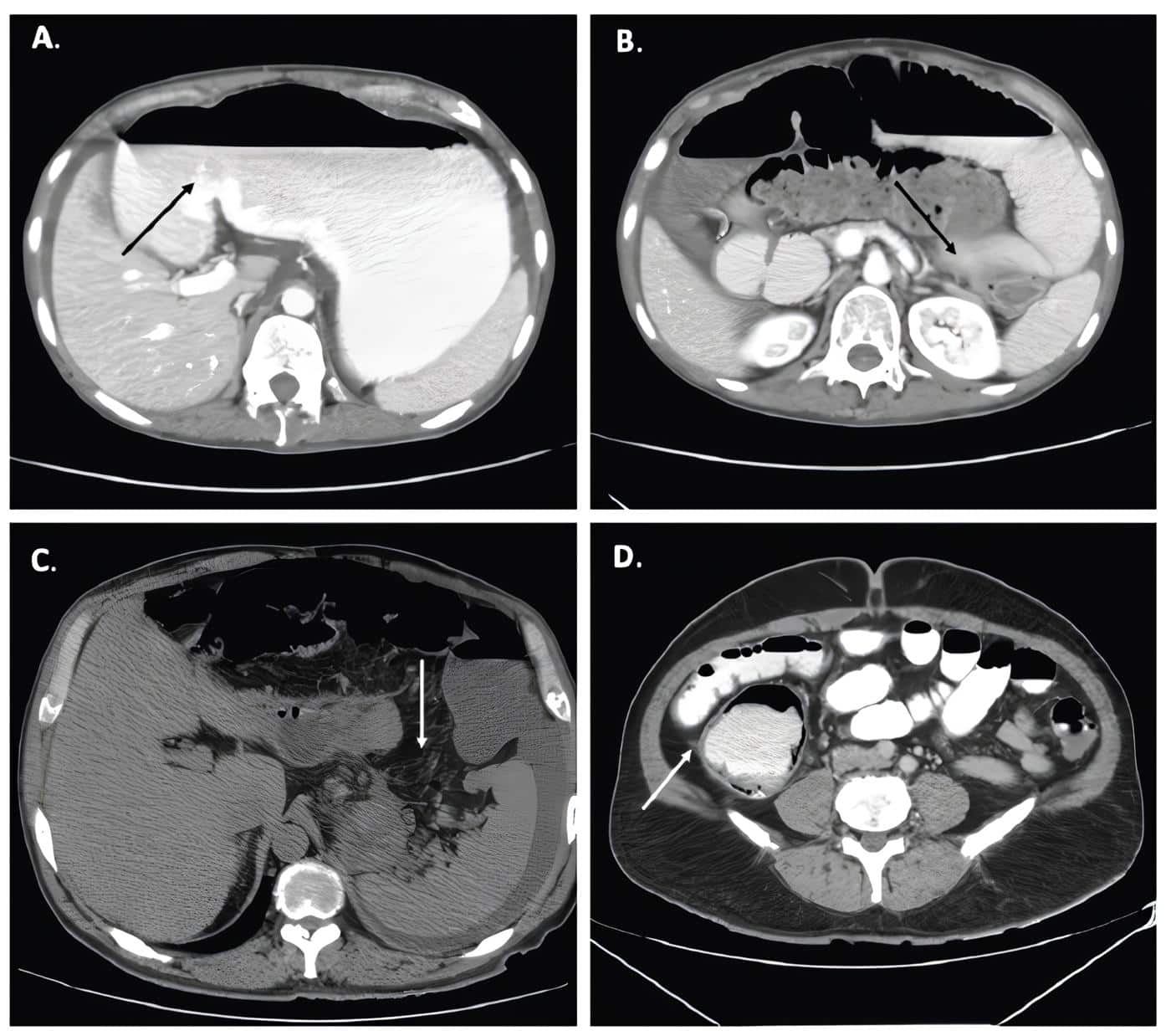 Dilatación de las asas intestinales delgadas