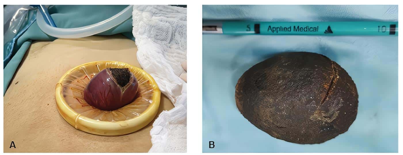 Enterotomía para extracción de cálculo biliar Enterotomía para extracción de cálculo biliar