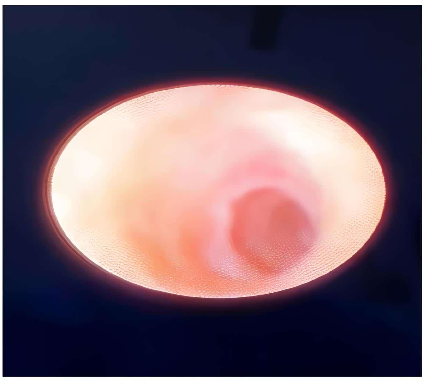 Estenosis del conducto post dilatación Estenosis del conducto post dilatación