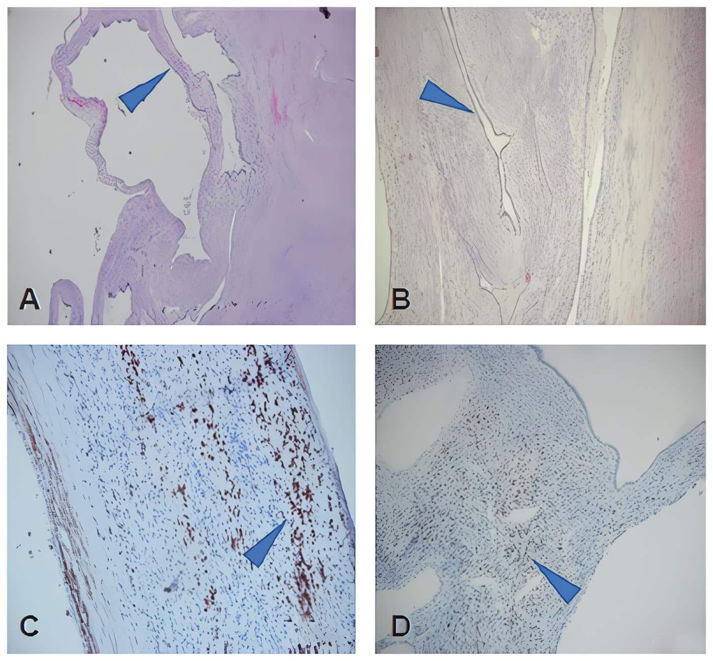 Estructuras quísticas tapizadas por epitelio cúbico simple Estructuras quísticas tapizadas por epitelio cúbico simple