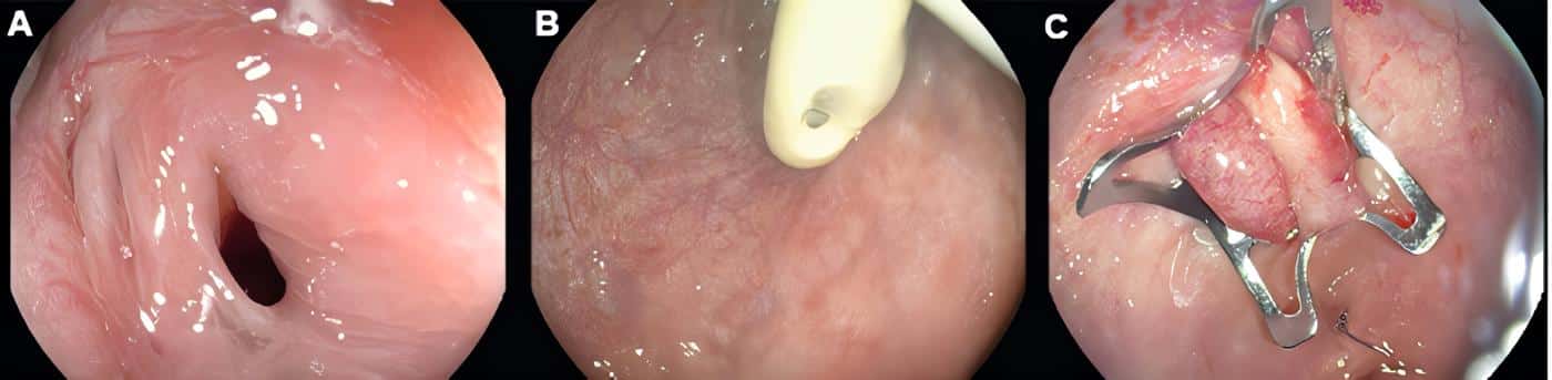 Fistula rectovesical - Tracto Gastrointestinal con Clip sobre el Endoscopio Fistula rectovesical - Tracto Gastrointestinal con Clip sobre el Endoscopio