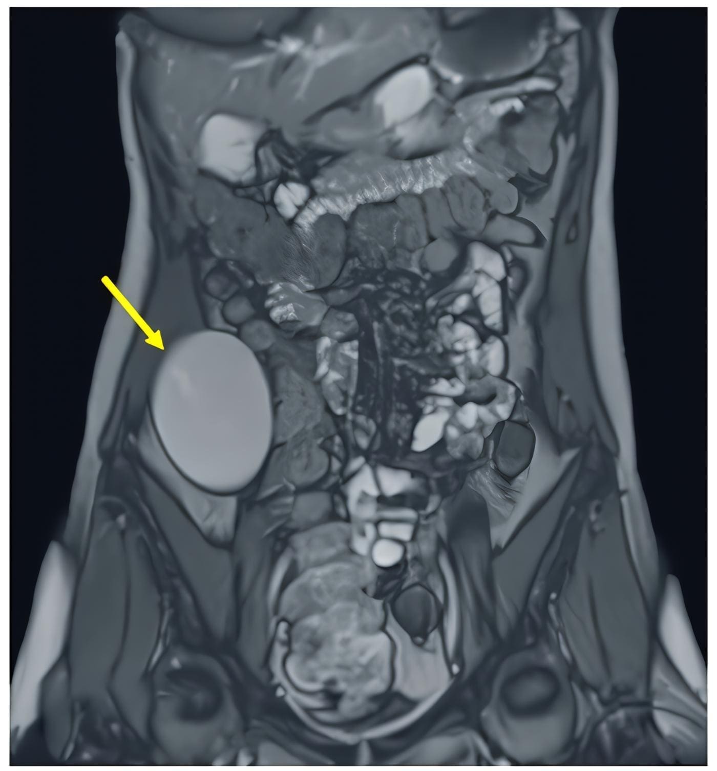 En flanco y fosa iliaca derechos se identifica una formación quística unilocular En flanco y fosa iliaca derechos se identifica una formación quística unilocular