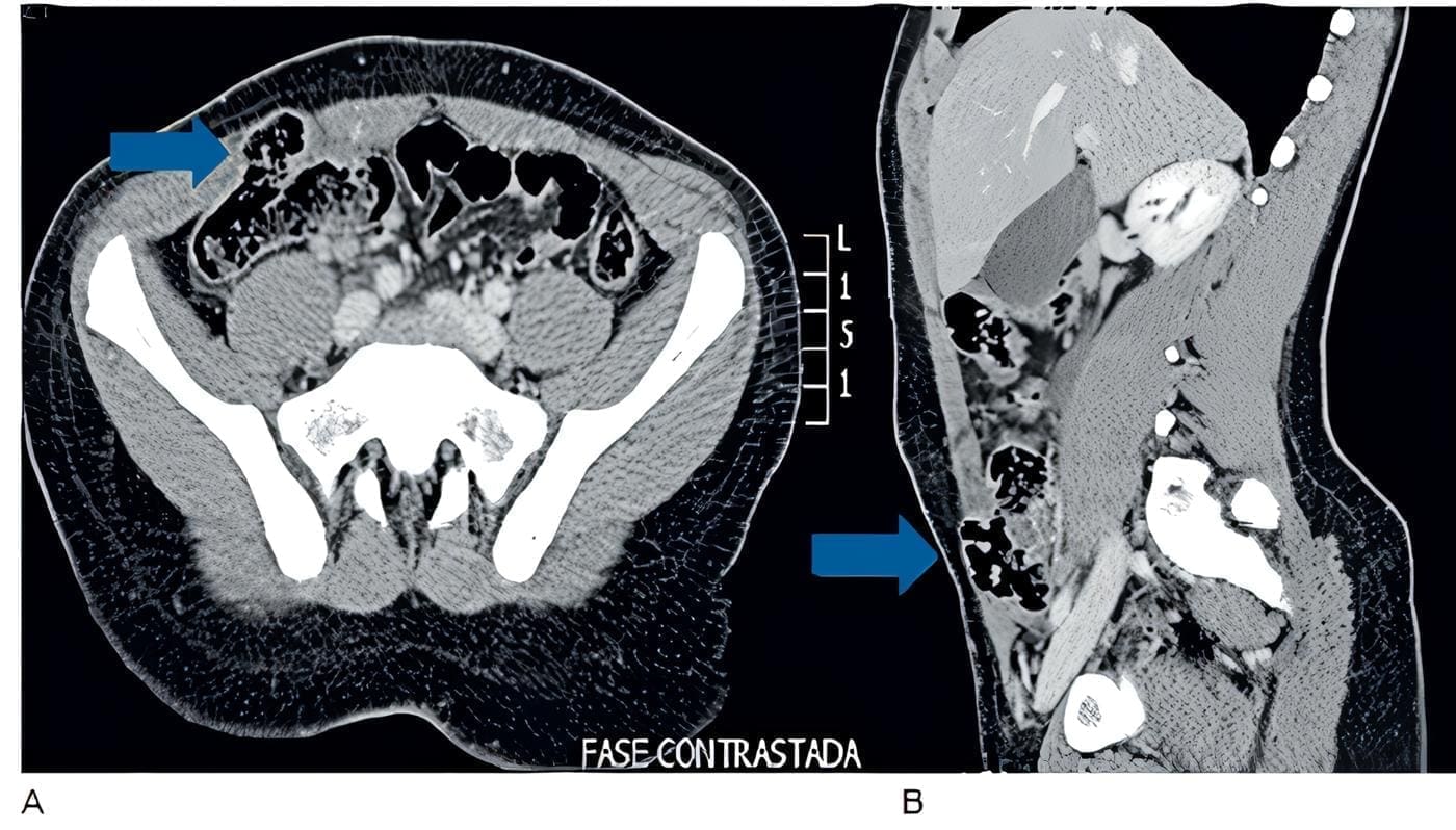 Hernia traumática de la pared abdominal.