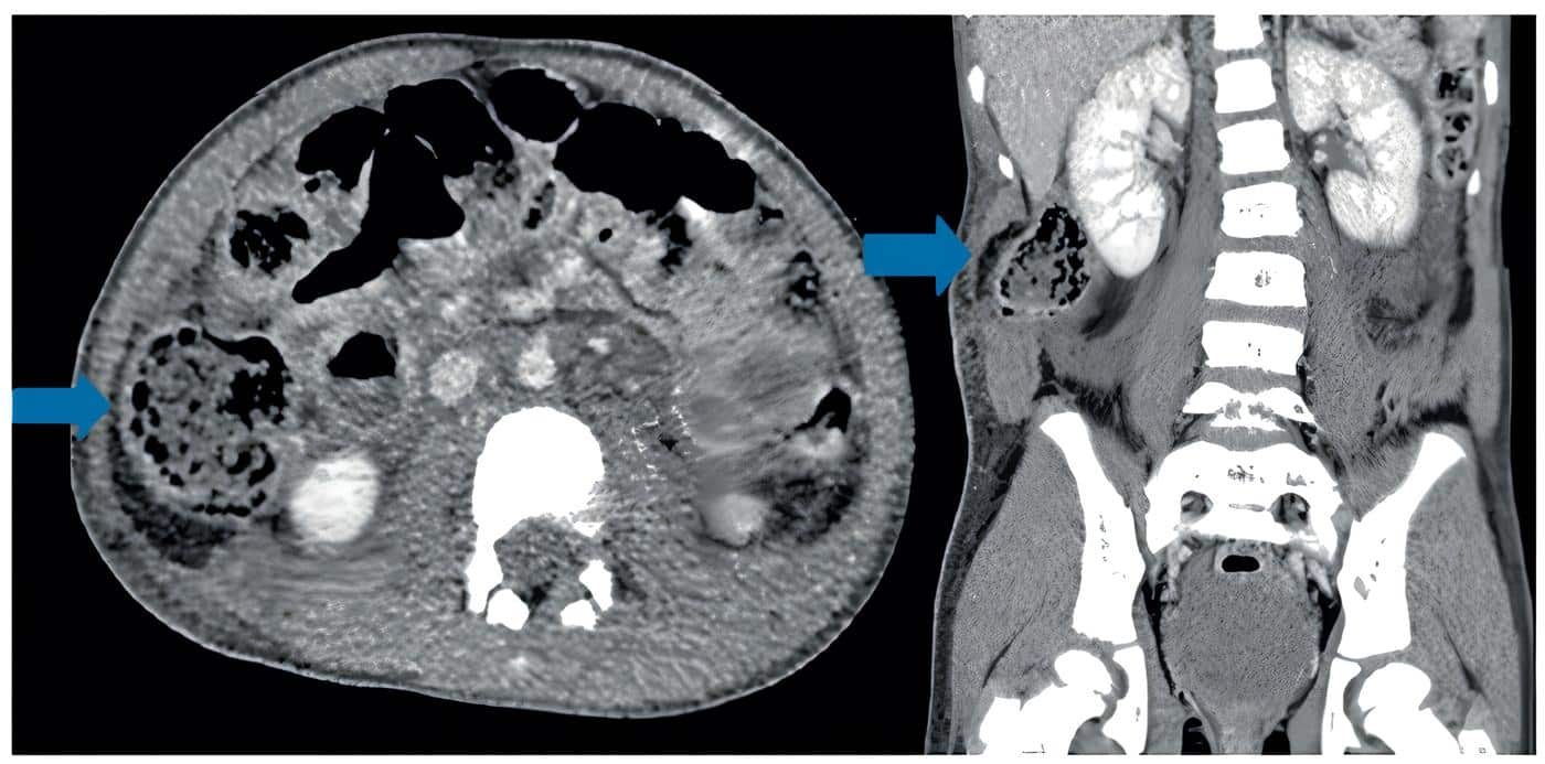 Herniación visceral en el flanco derecho