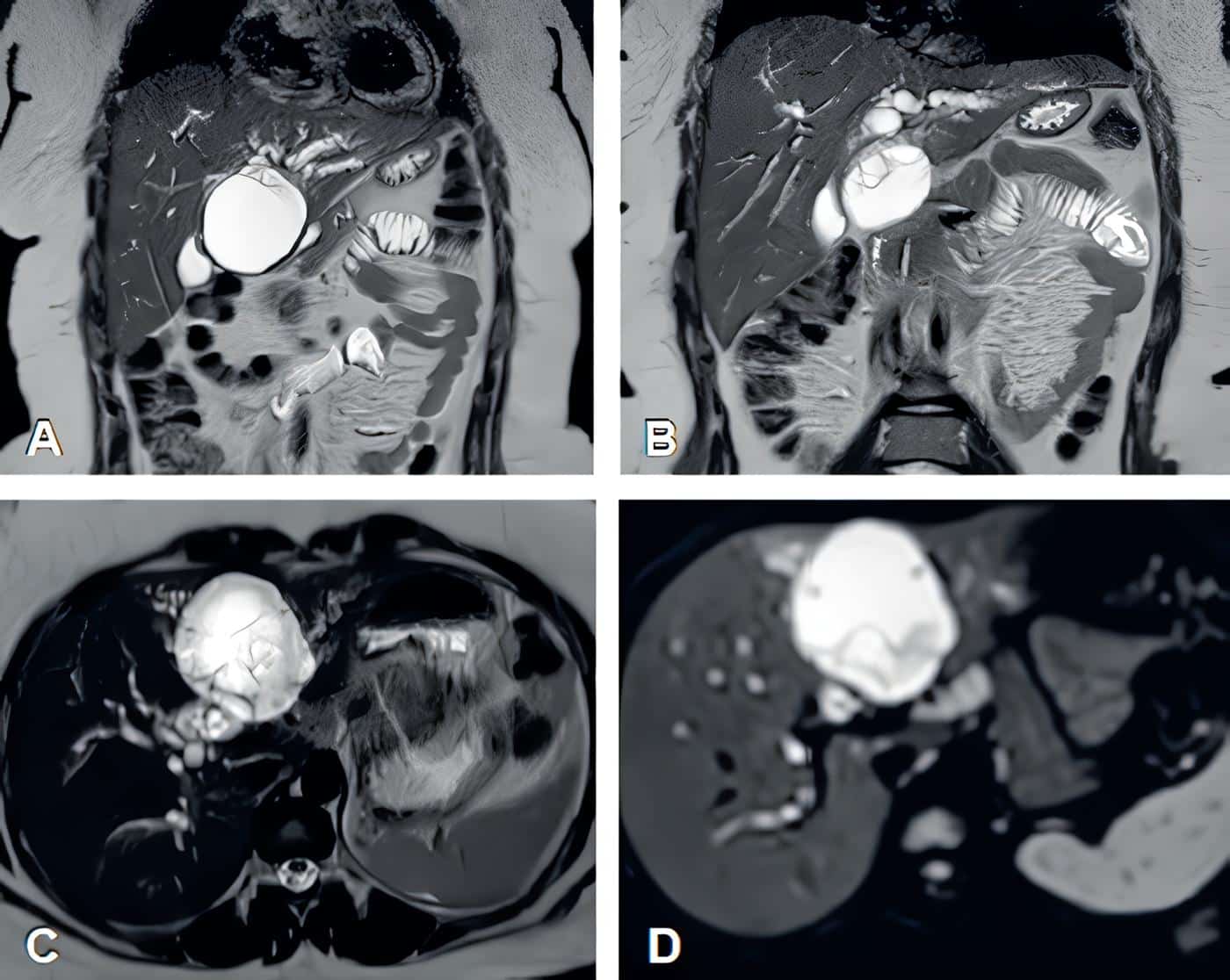 Cortes coronales de colangiorresonancia en secuencia T2 donde se observa la imagen quística Cortes coronales de colangiorresonancia en secuencia T2 donde se observa la imagen quística