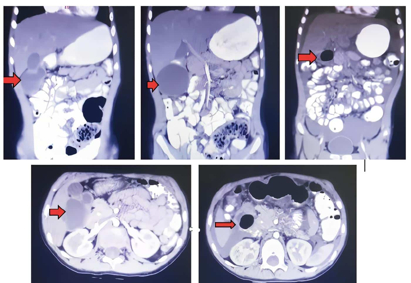 Imagen quística entre el hígado, riñón derecho y colon Imagen quística entre el hígado, riñón derecho y colon