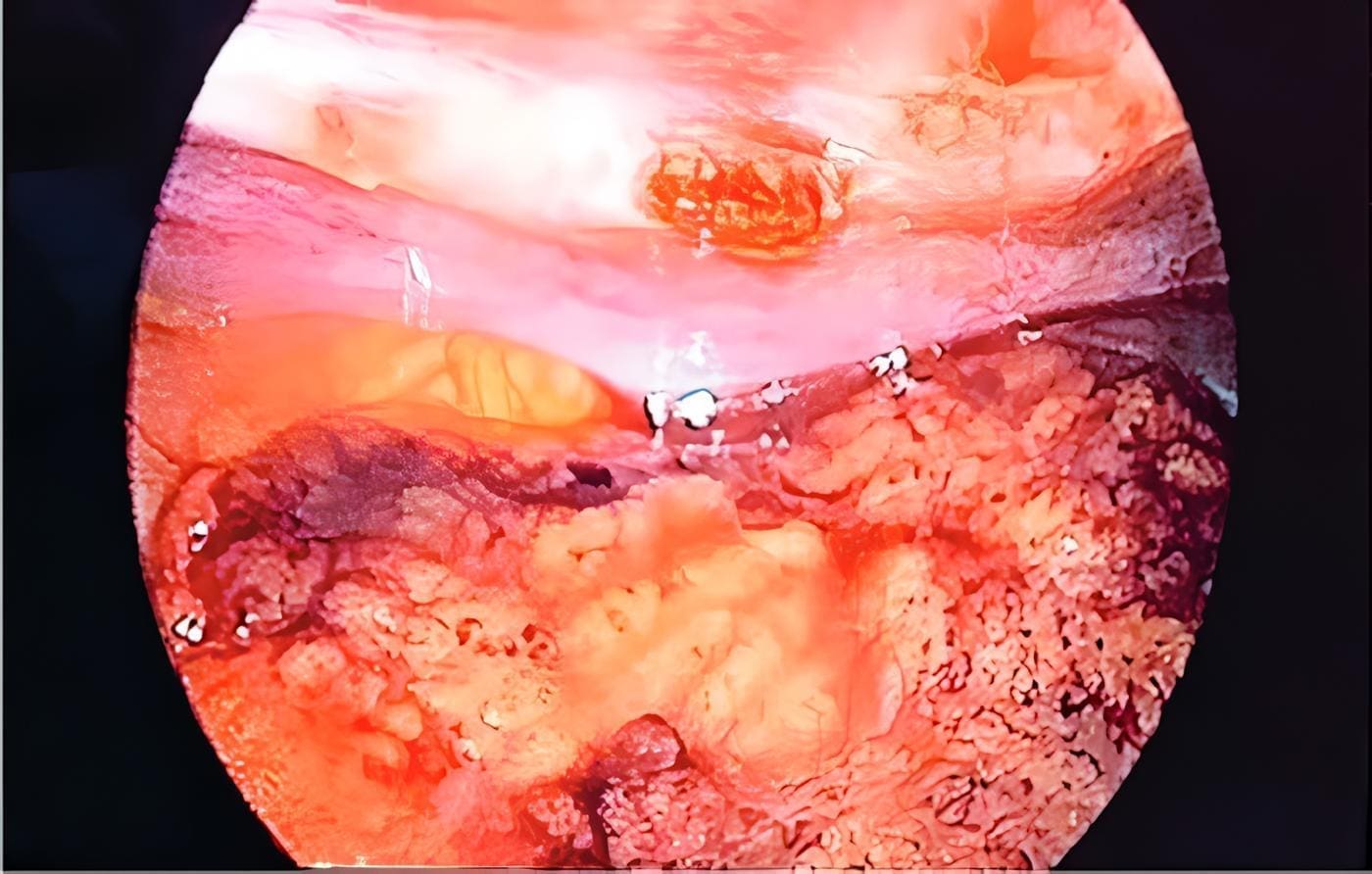Infarto del sector superior derecho del omento. Infarto del sector superior derecho del omento.