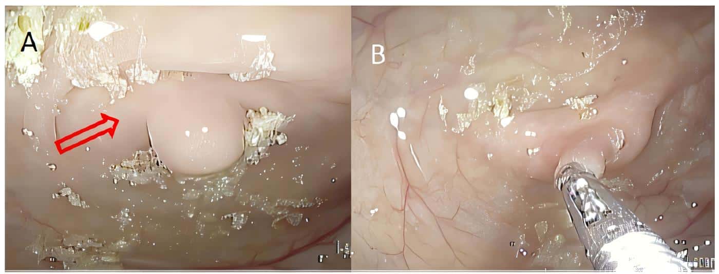 Inversión del muñón apendicular