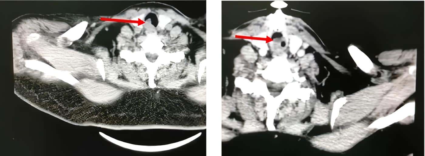 Lesión endoluminal Lesión endoluminal