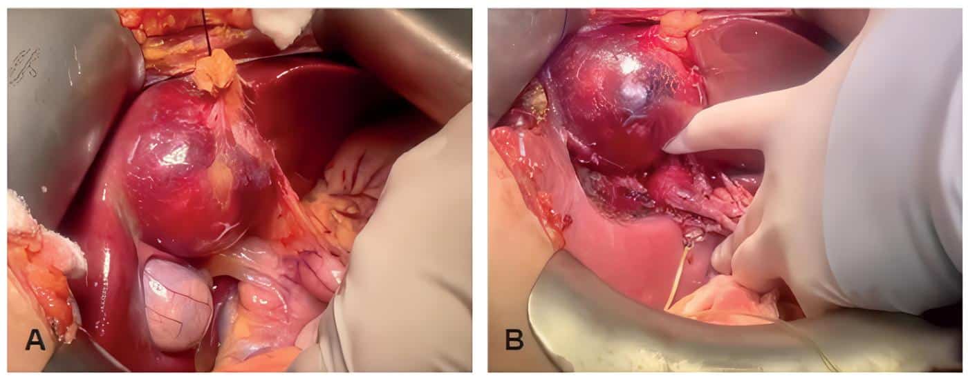 Lesión en el segmento hepático - Neoplasia Quística Mucinosa Lesión en el segmento hepático - Neoplasia Quística Mucinosa
