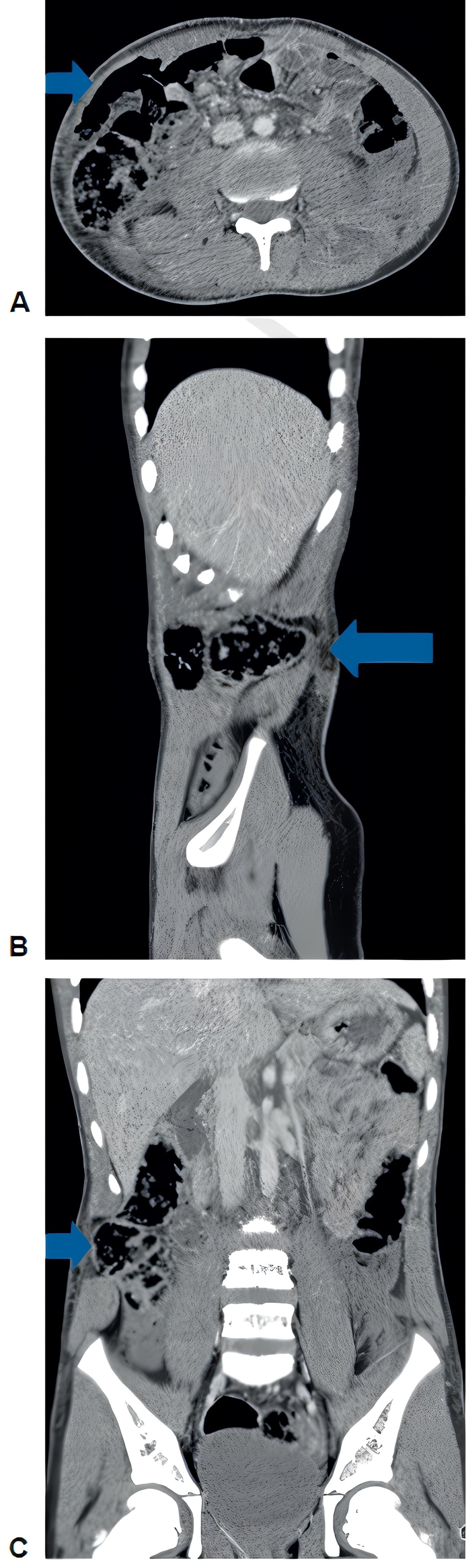 Localización de la hernia traumática