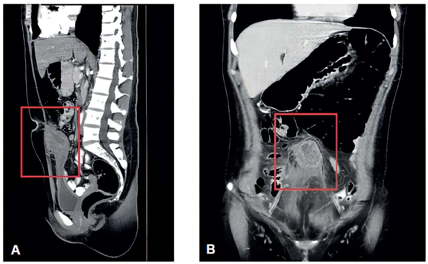 Masa intraperitoneal extendiéndose desde la región umbilical y hasta la pared superior Masa intraperitoneal extendiéndose desde la región umbilical y hasta la pared superior