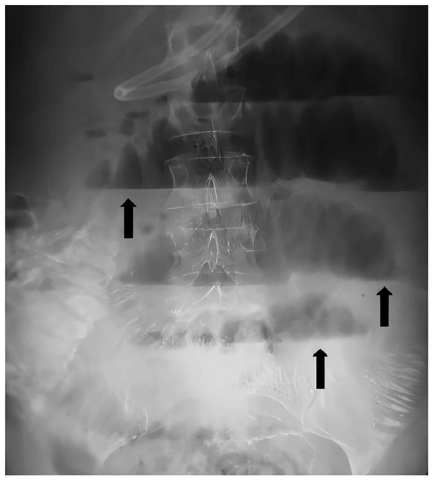 Niveles hidroaéreos centrales en escalera y la distensión de asas intestinales delgadas.