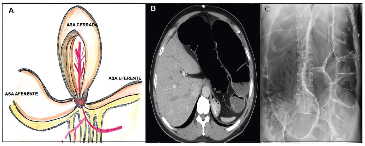 Representación esquemática y radiológica de obstrucción en asa cerrada