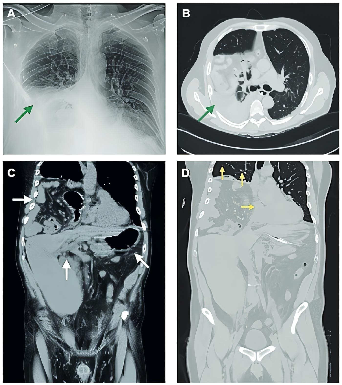 Radiografía  posteroanterior  con  opacidad  en  hemitórax  derecho.  Radiografía  posteroanterior  con  opacidad  en  hemitórax  derecho.