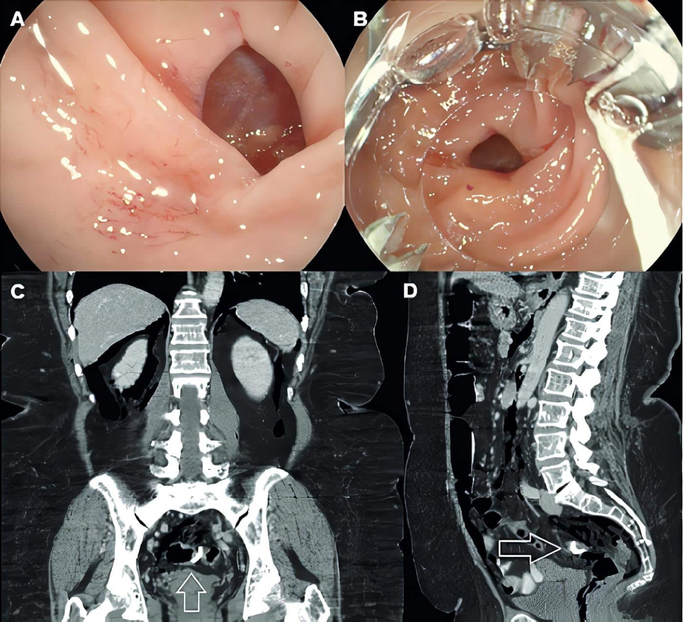 Perforación a nivel de unión rectosigmoidea durante colonoscopia diagnóstica Perforación a nivel de unión rectosigmoidea durante colonoscopia diagnóstica