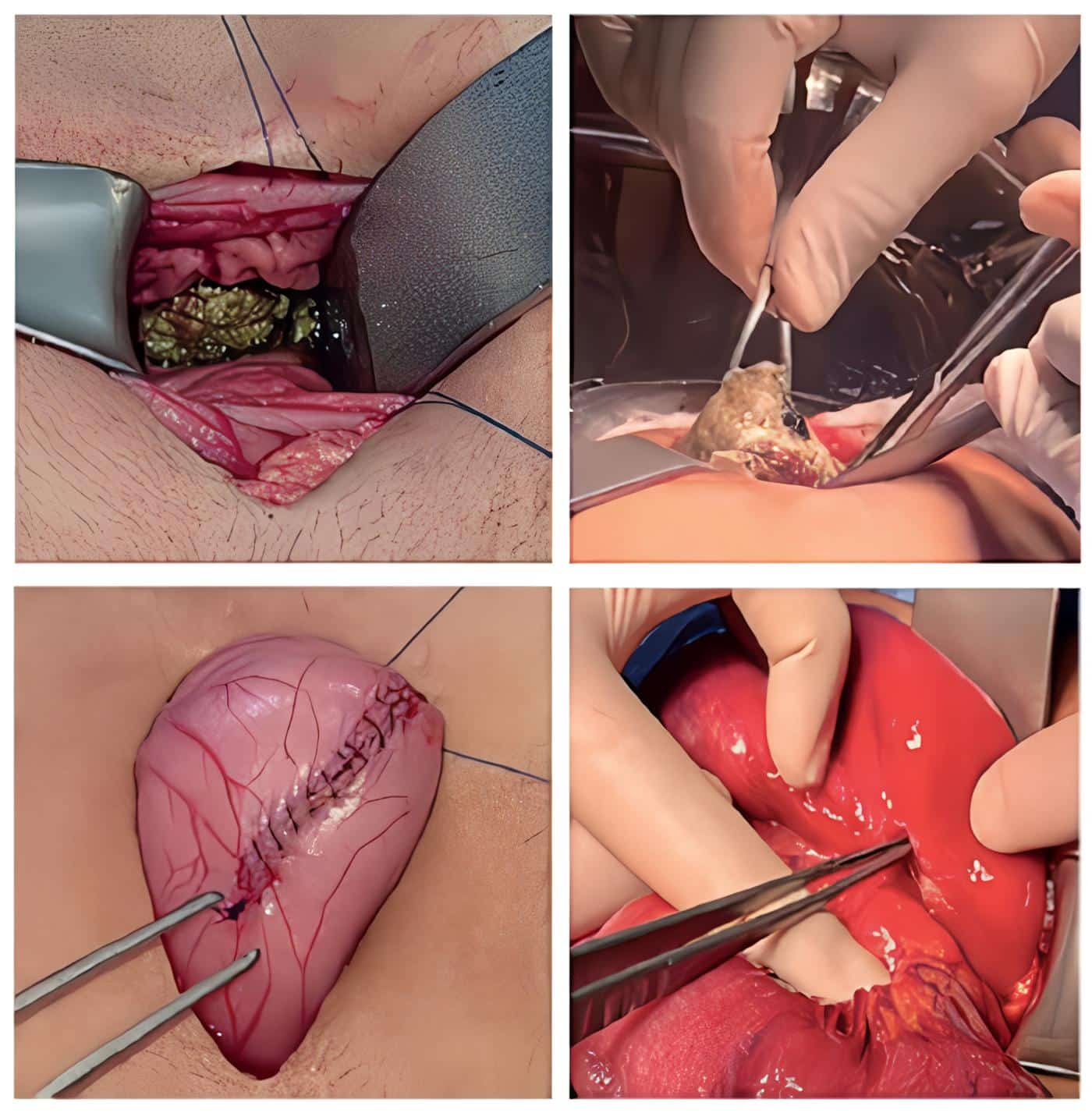 Perforación yeyunal con una úlcera contenida