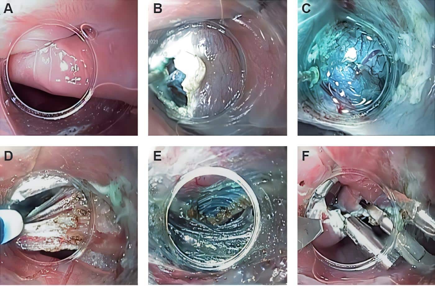 Imágenes del procedimiento endoscópico. Imágenes del procedimiento endoscópico.