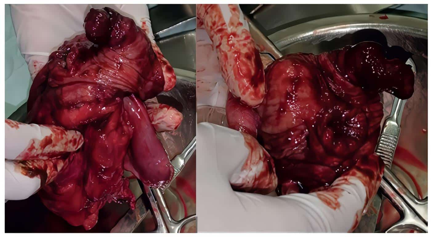 Intususcepción del 80 % del apéndice sobre el ciego, focos hemorrágicos y nódulos pericecales