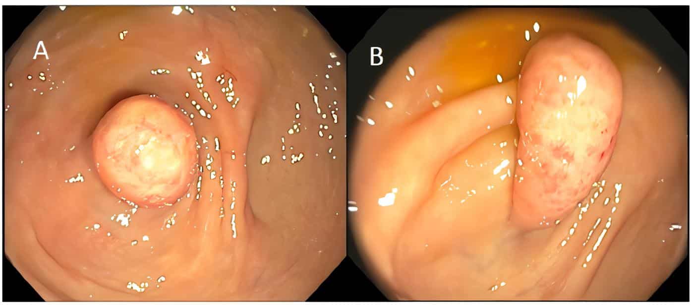 Punta del apéndice cecal