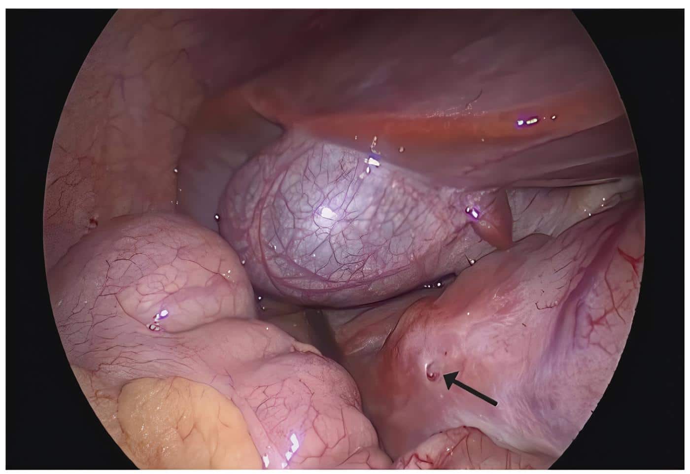 Quiste duodenal ubicado en la primera porción del duodeno Quiste duodenal ubicado en la primera porción del duodeno