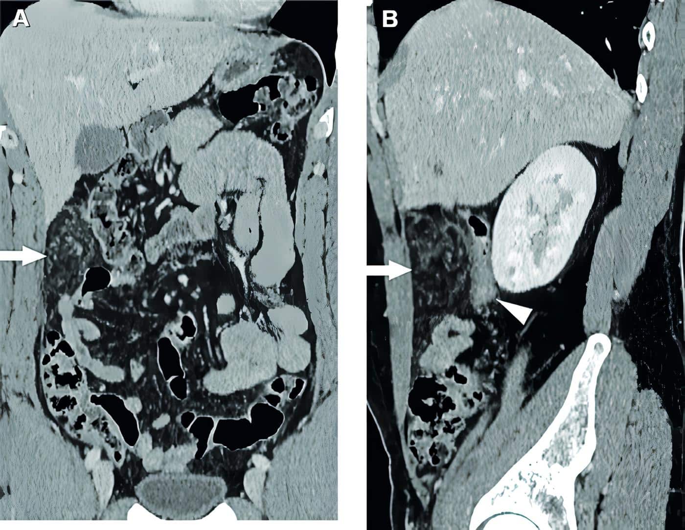 Reconstrucción en plano coronal Reconstrucción en plano coronal