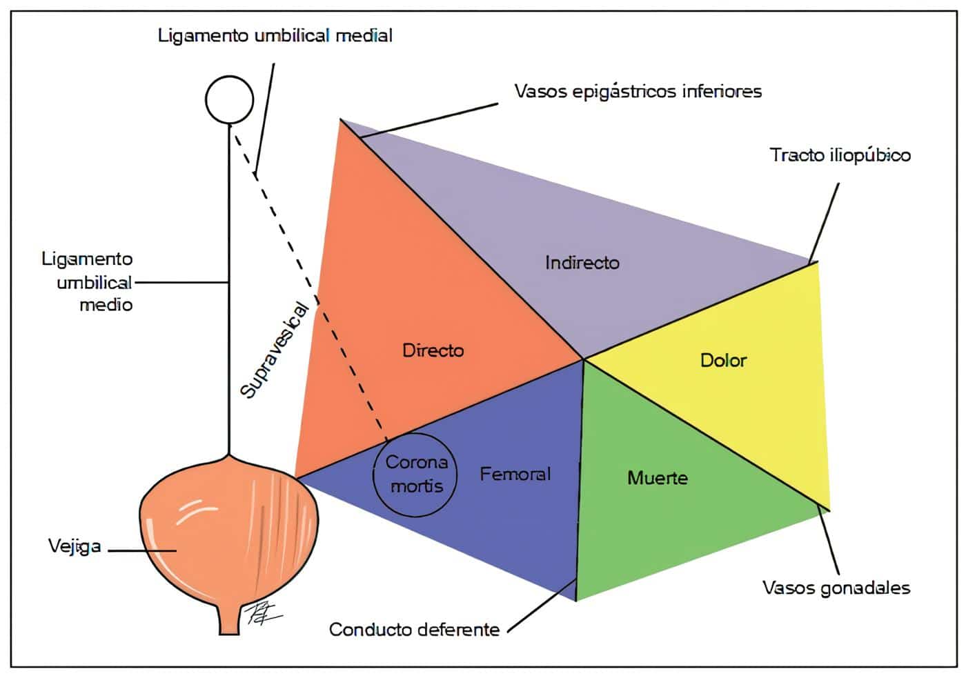 Triángulos de la región inguinal y espacio extraperitoneal Triángulos de la región inguinal y espacio extraperitoneal