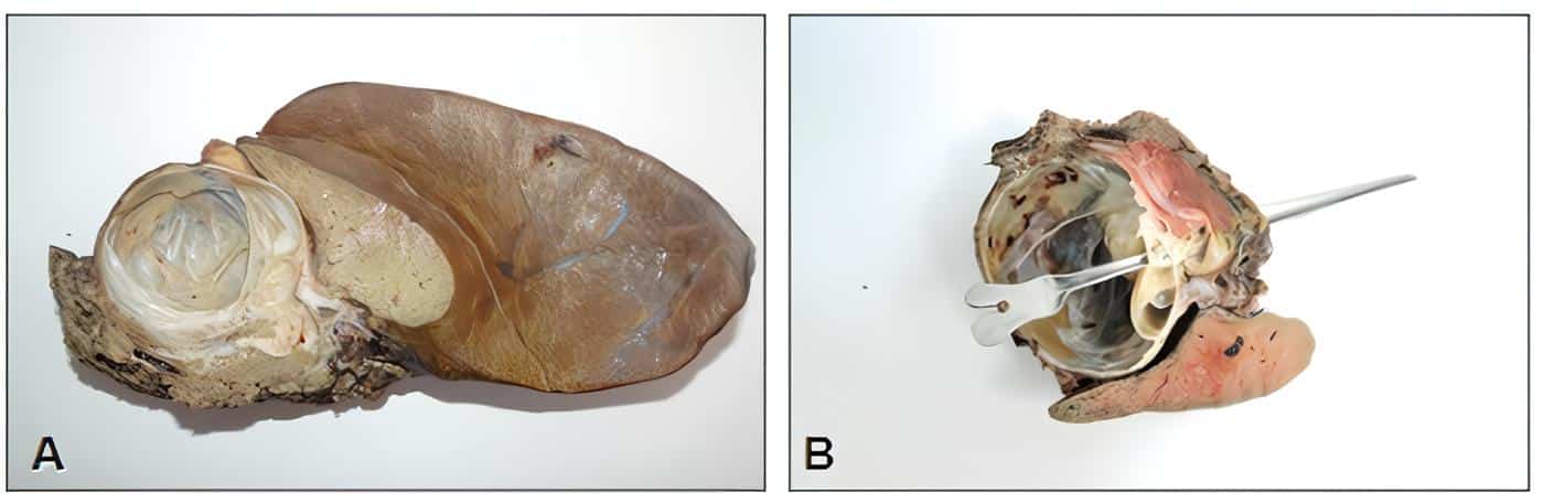 Segmento hepático con la masa quística - Neoplasia Quística Mucinosa Segmento hepático con la masa quística - Neoplasia Quística Mucinosa