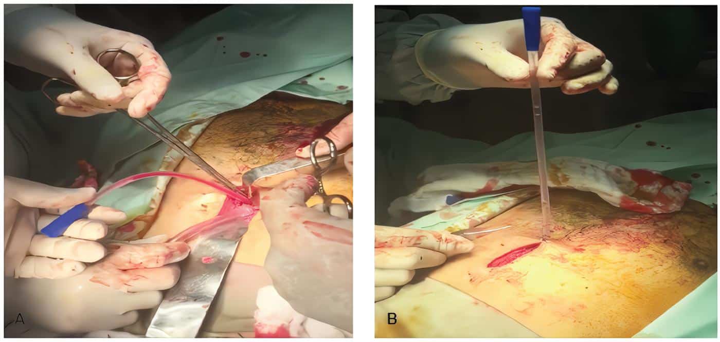Sonda Nelaton 10 Fr dentro de saco pericárdico Sonda Nelaton 10 Fr dentro de saco pericárdico