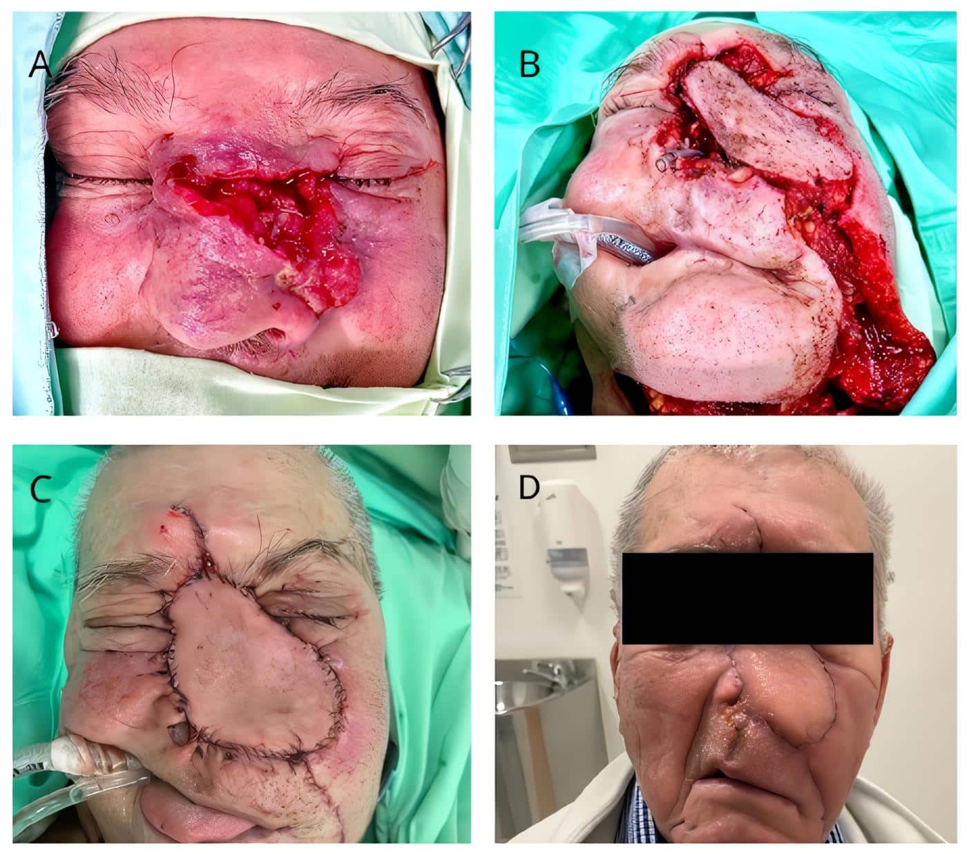 Técnica quirúrgica CTAS estándar Técnica quirúrgica CTAS estándar