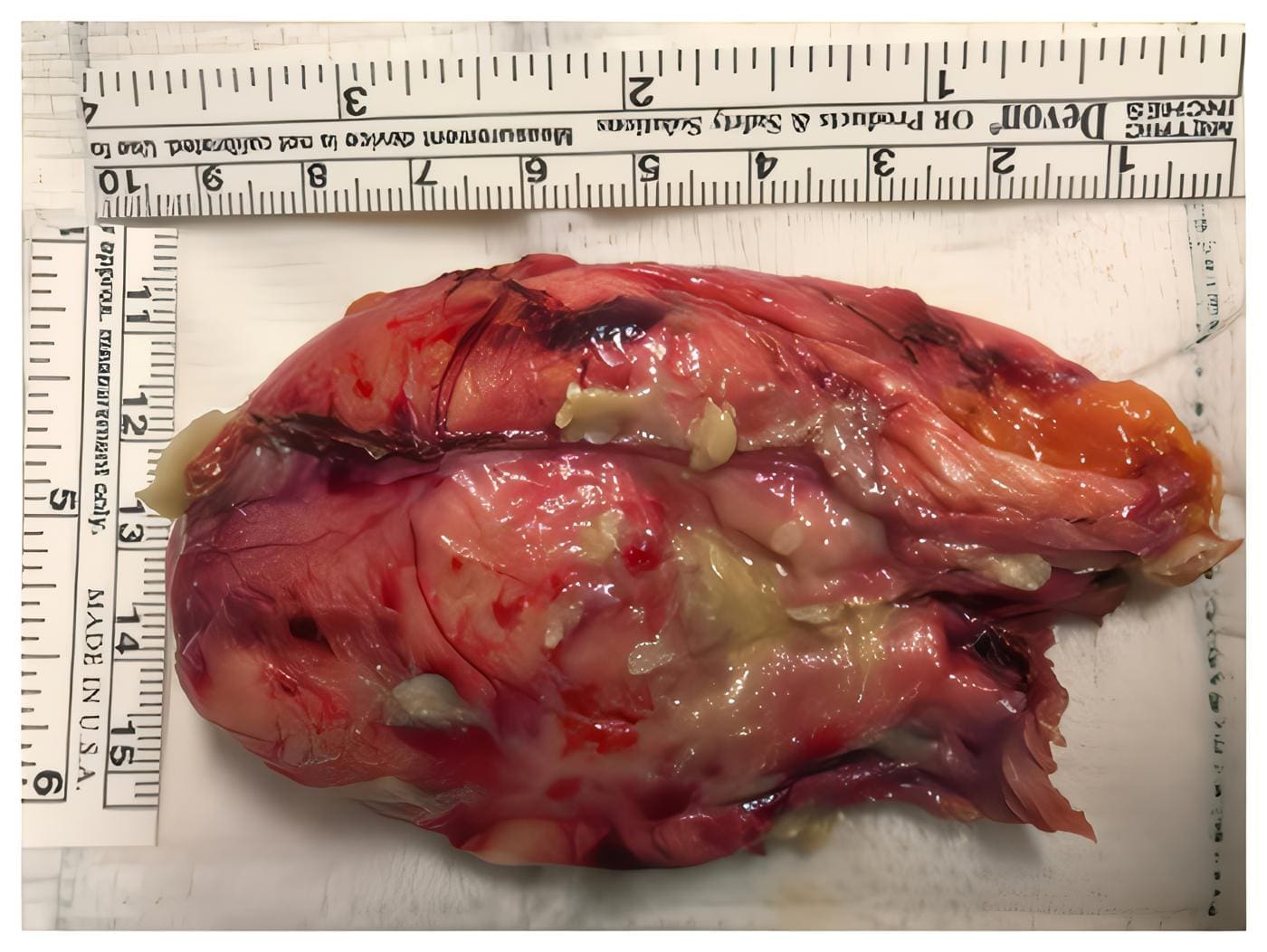 Teratoma maduro Teratoma maduro