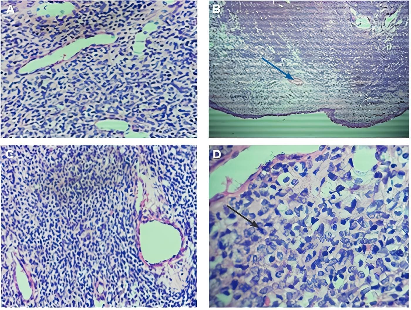 Tinción de hematoxilina-Eosina - Tumor Glómico Tinción de hematoxilina-Eosina - Tumor Glómico