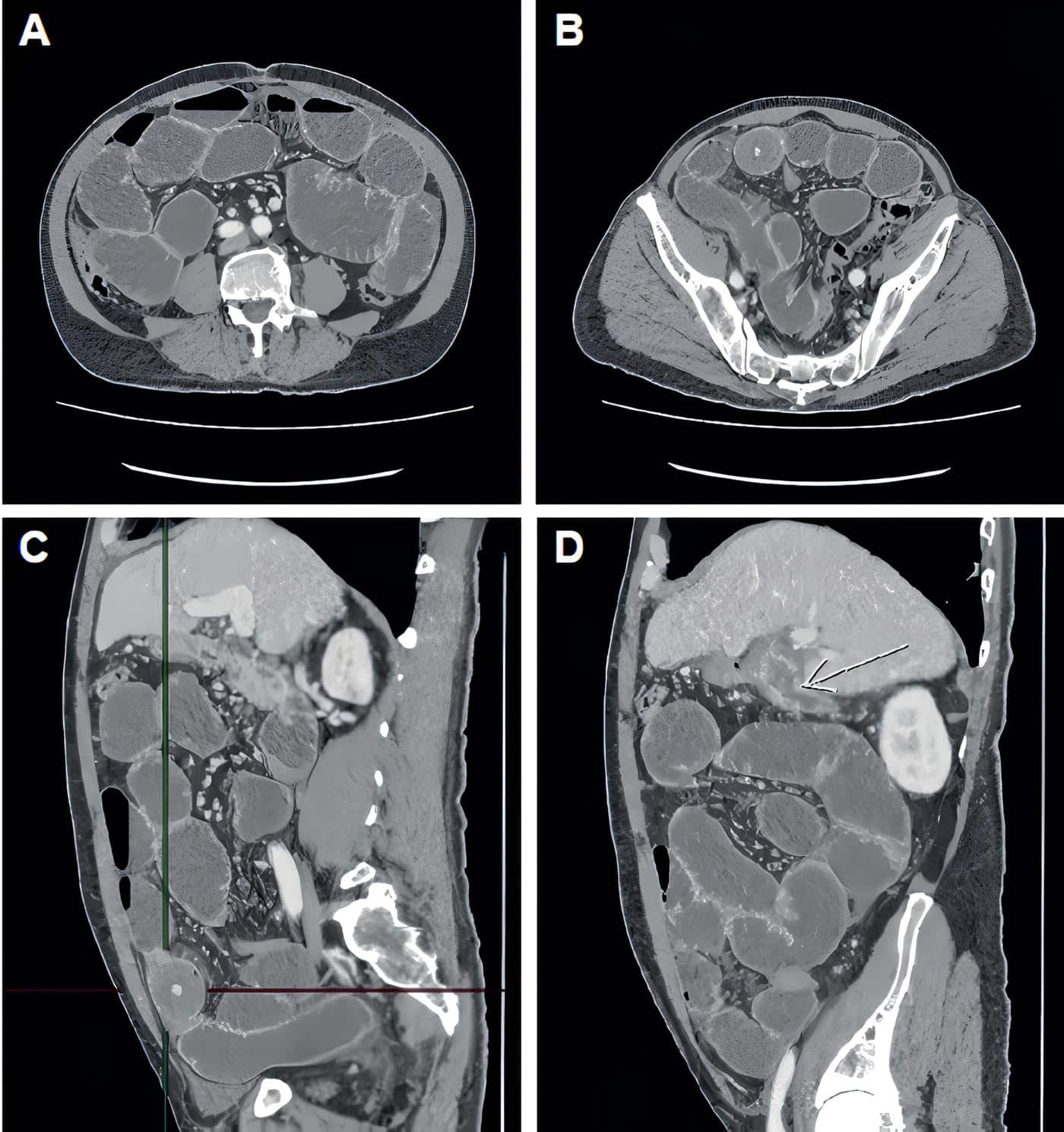 Tomografía computarizada de abdomen y pelvis Tomografía computarizada de abdomen y pelvis