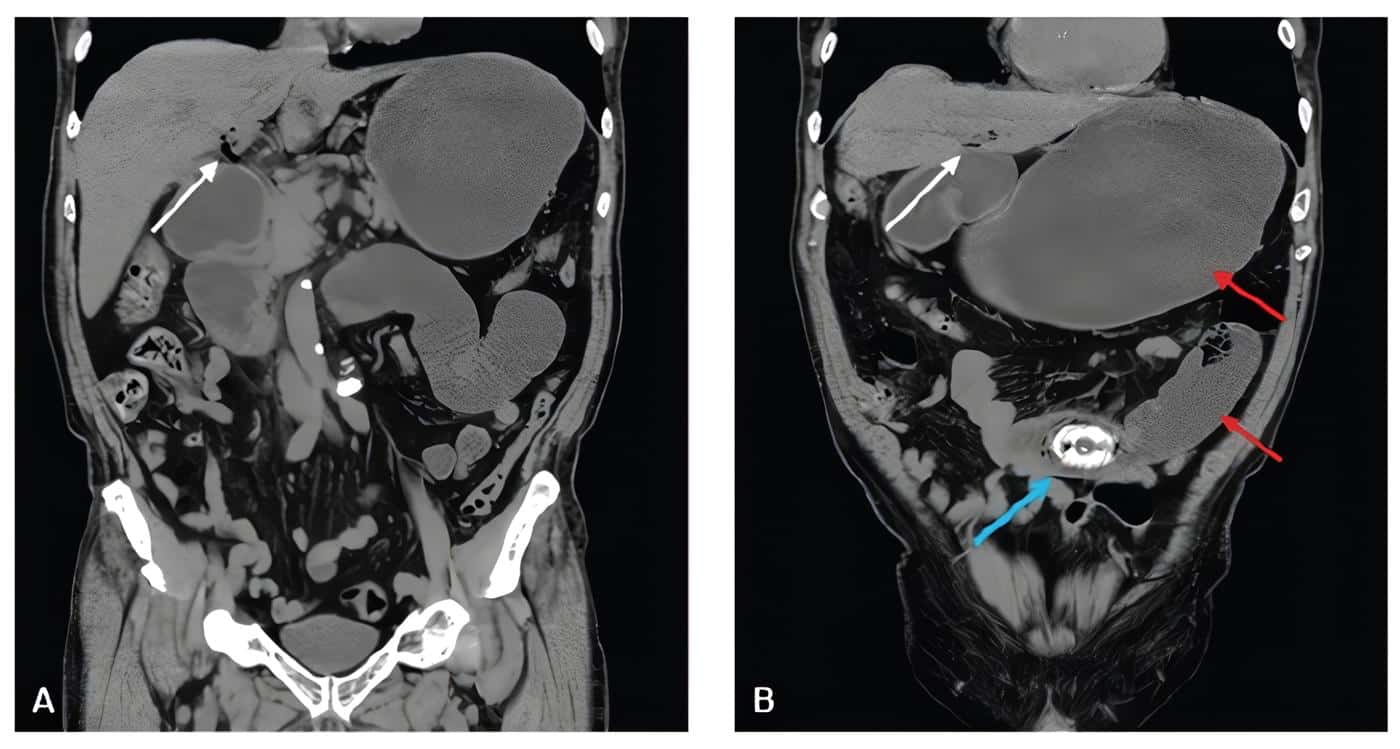 Tomografía abdominal simple en corte coronal - neumobilia Tomografía abdominal simple en corte coronal - neumobilia