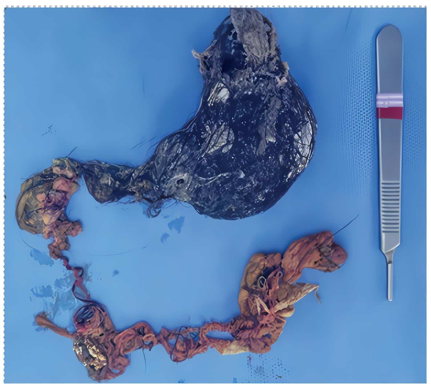 Tricobezoar con extensión al duodeno conformando el “síndrome de Rapunzel”