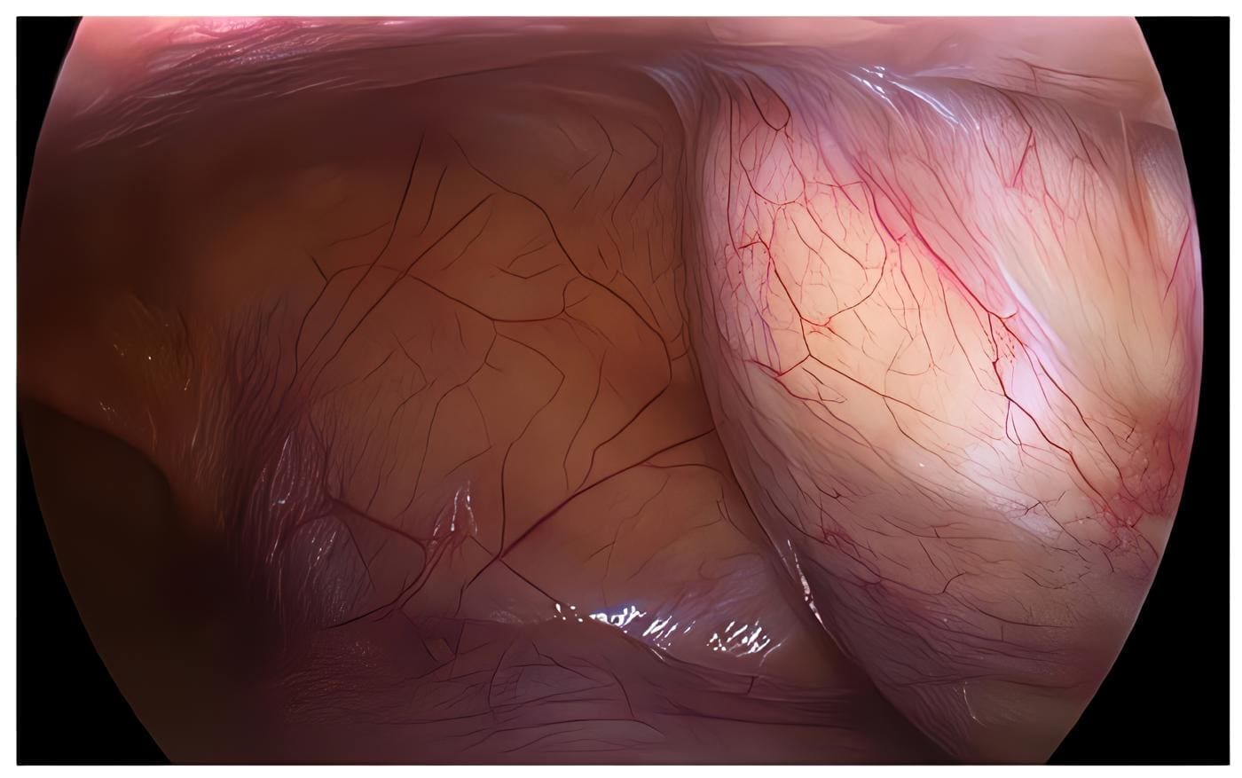 Tumoración quística a tensión - Teratoma Maduro Tumoración quística a tensión - Teratoma Maduro