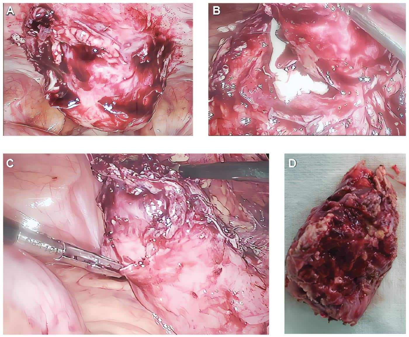 Vista laparoscópica del quiste de uraco Vista laparoscópica del quiste de uraco
