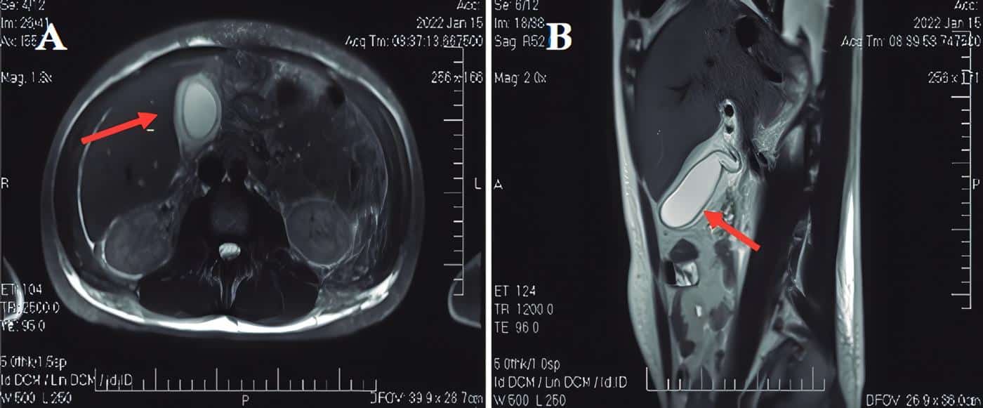 Magnetic Resonance Cholangiography