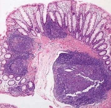 enfermedad-hirschsprung-diagnostico-1.jpg