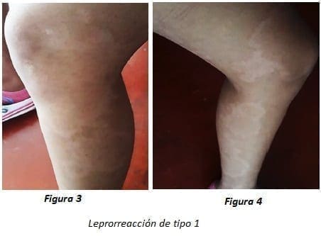 Leproreaccion-tipo1-anm126.jpg