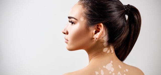 Vitiligo.png