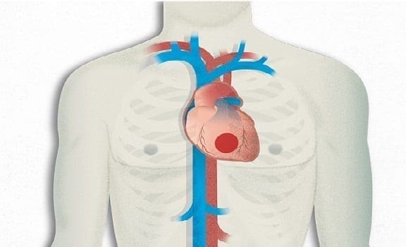 cardiopatia-isquemica.jpg