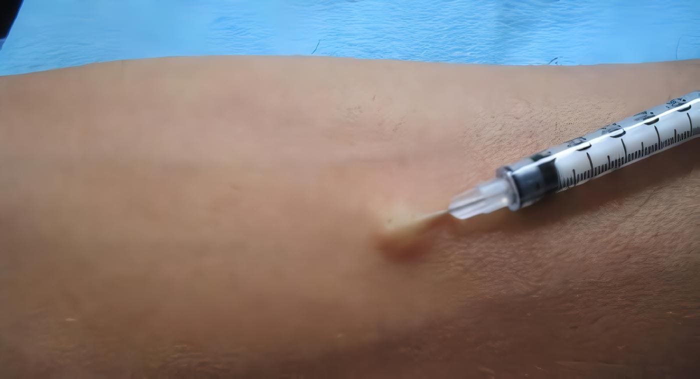 gastro181f4-lesion-benigna-yuxtacava.jpg